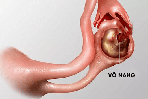 Vỡ u nang buồng trứng – Biến chứng nguy hiểm cần cấp cứu kịp thời